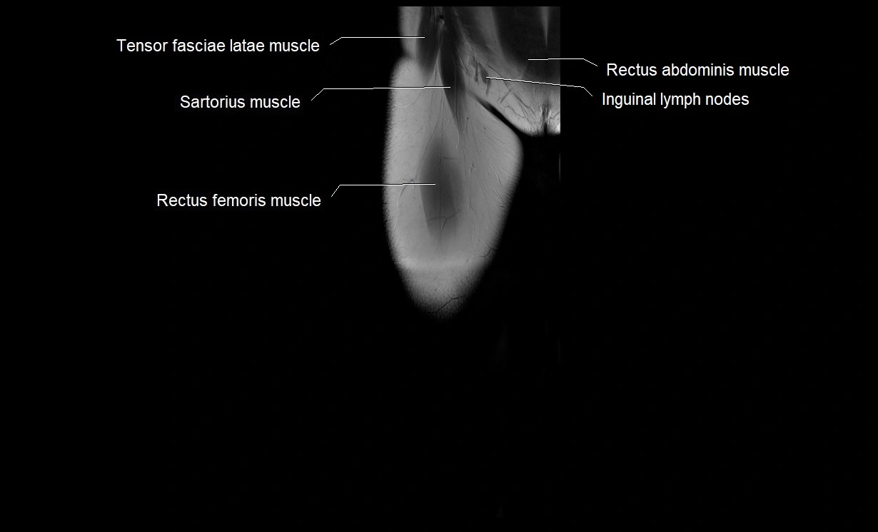 MRI thigh coronal cross sectional anatomy image 2.webp